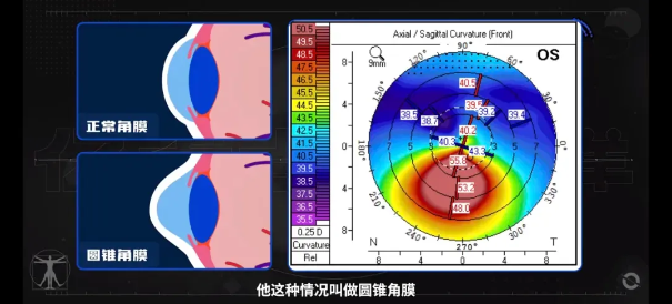 近视锥角膜