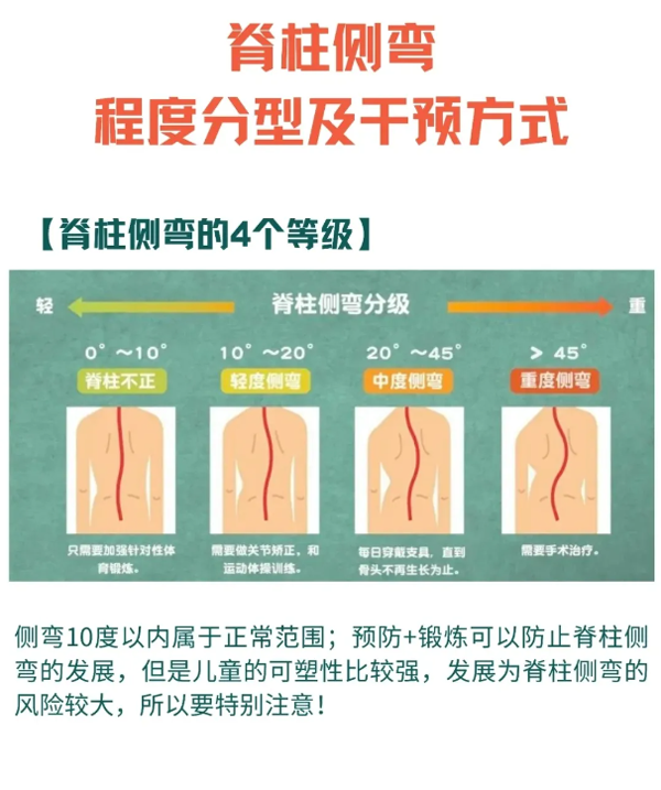 脊柱侧弯程度分型