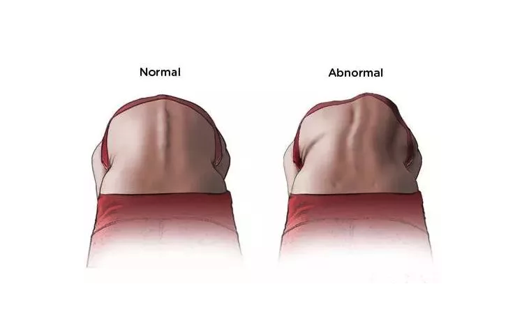让孩子远离脊柱侧弯，“挺直腰板”